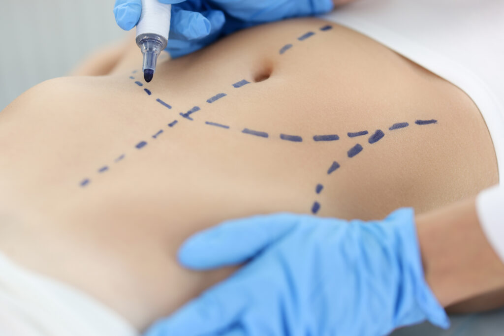 Plastic surgery body contouring planning markings
